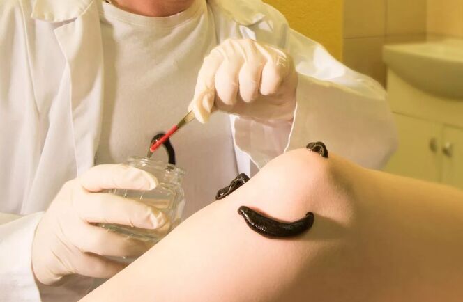 Hirudothérapie pour les varices