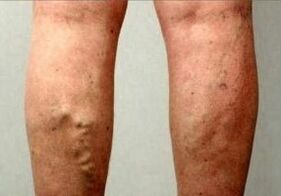 Thromboembolie
