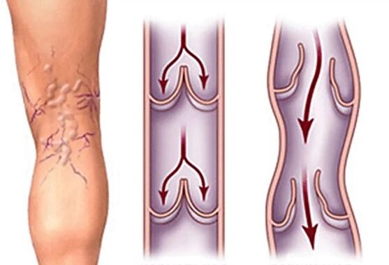 Vena et crampe normaux