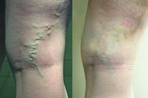 Varices sur les jambes