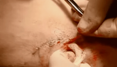 Types d'opérations pour éliminer les varices