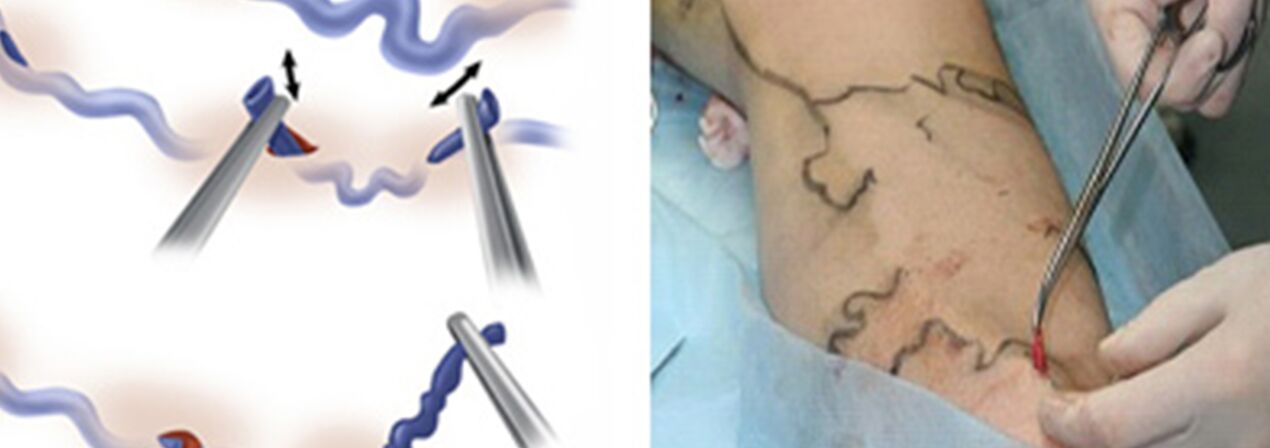 Traitement chirurgical des veines