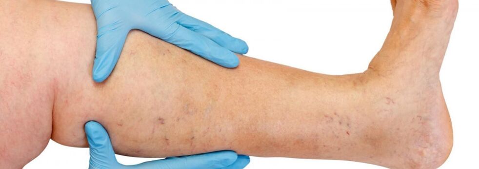 Varices sur la jambe