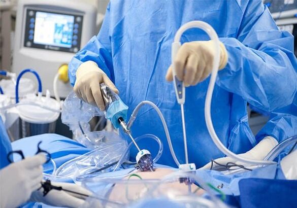 traitement chirurgical des varices dans la région pelvienne