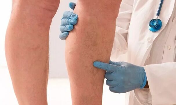 Un médecin examine les jambes à la recherche de varices